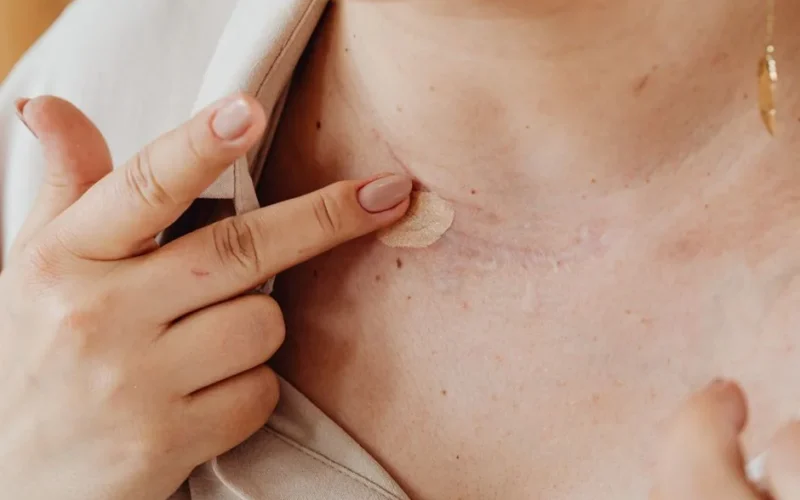 A person applies concealer on a neck scar with manicured nails in a close-up shot.