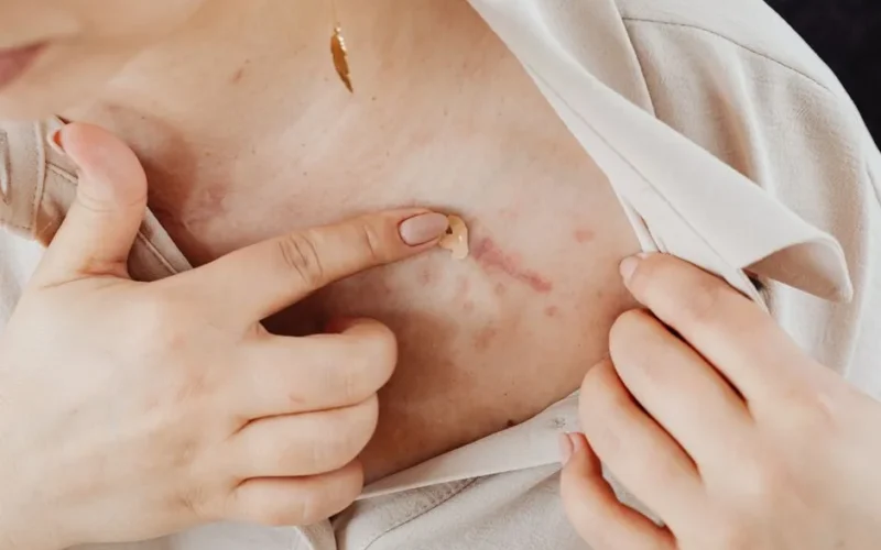 Close-up view of a woman applying cosmetic product to a scar on her chest.
