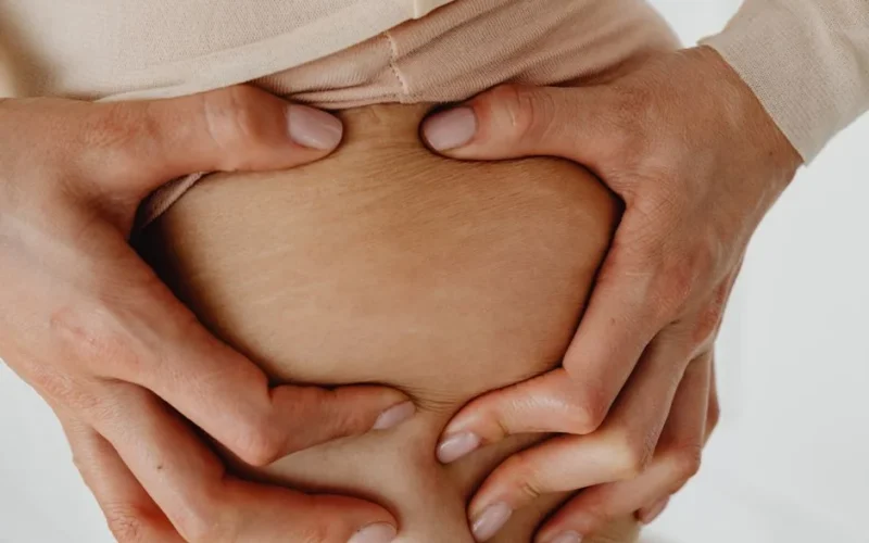 A detailed close-up showing a woman's hands holding her skin, focusing on stretch marks.