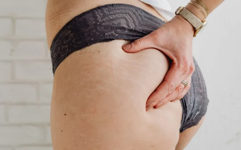 Detailed view of stretch marks on adult skin with lace underwear, showcasing body positivity.