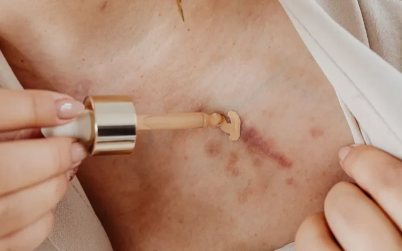 Applying concealer with a dropper to cover scars on skin in a close-up view.
